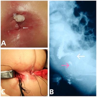 Anal canal duplication with heterotopic gastric mucosa and anal stenosis: first case report and literature review